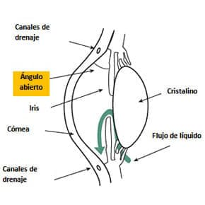 Glaucoma de ángulo abierto o crónico