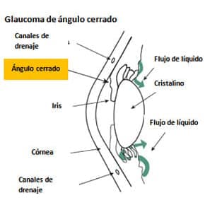 Glaucoma de ángulo cerrado o agudo