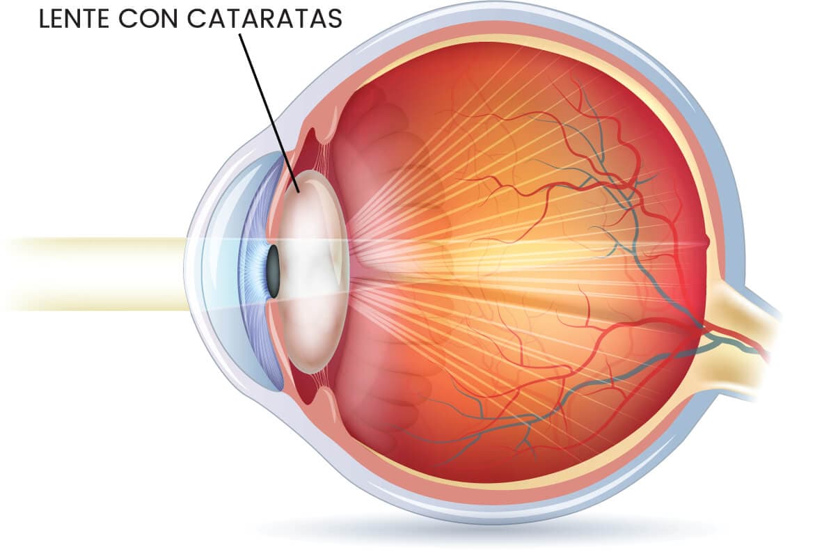 Ojo con cataratas