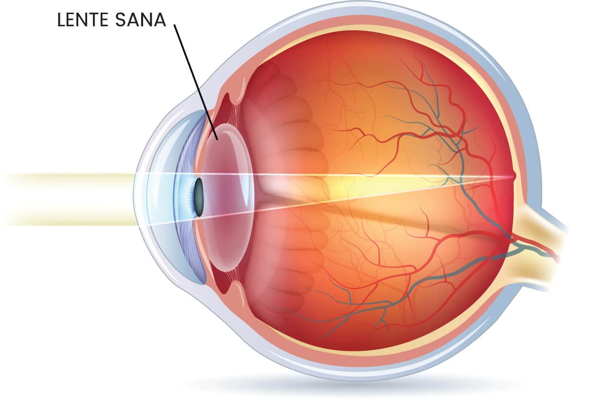 Ojo sano sin cataratas