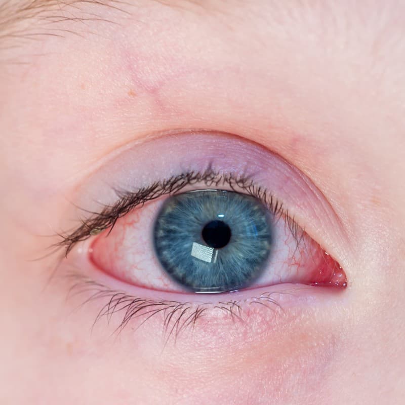 Glaucoma congénito