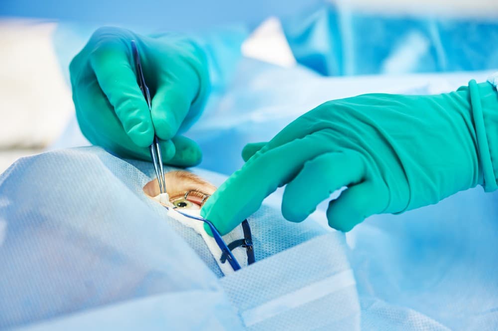 Datos de interés sobre la técnica Lasik