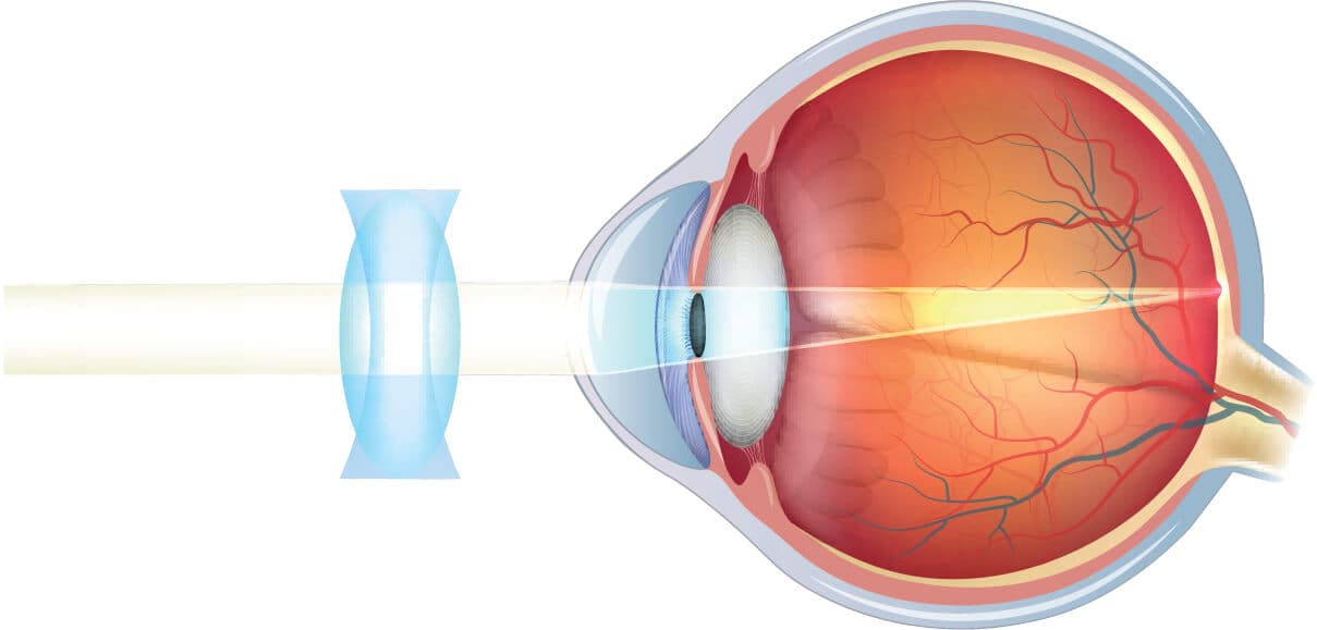 Ojo con lente correctora del astigmatismo