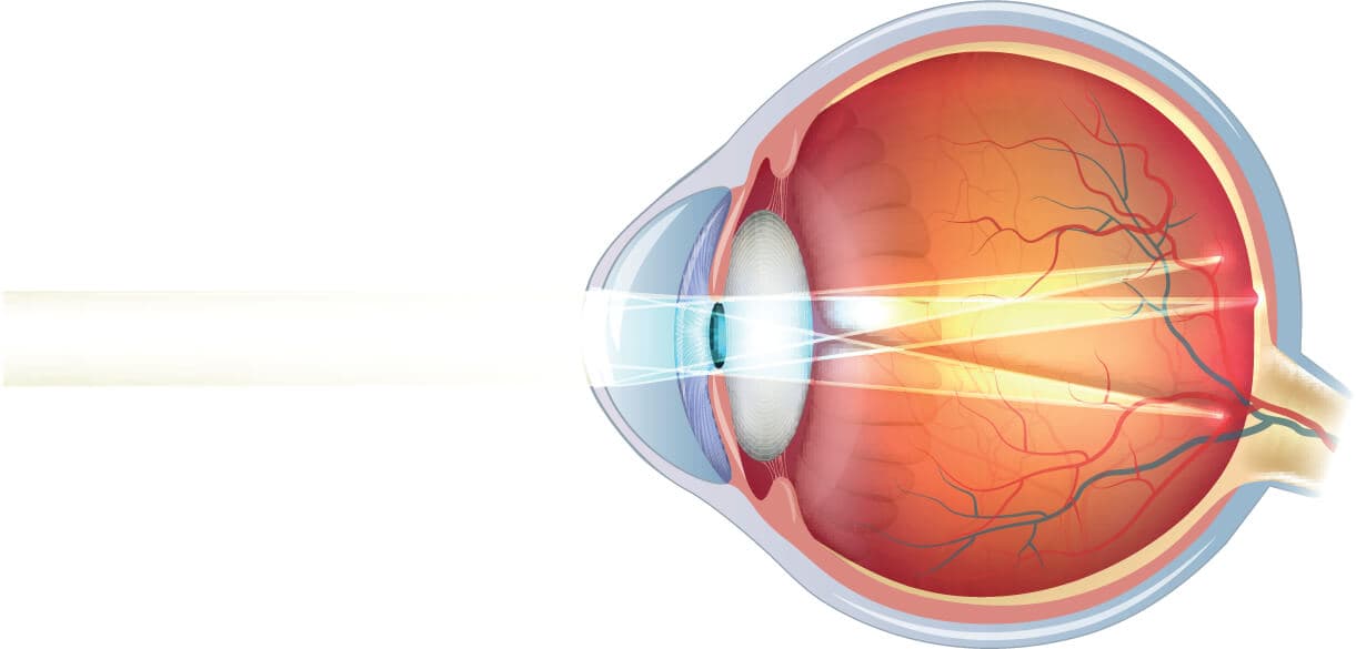 Ojo con astigmatismo sin operar