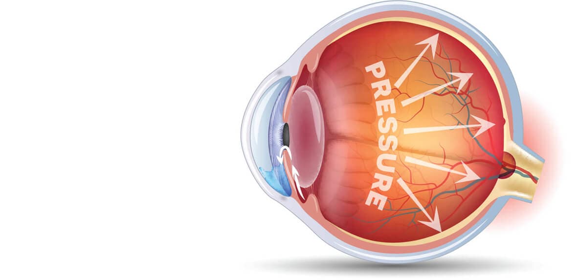 Glaucoma