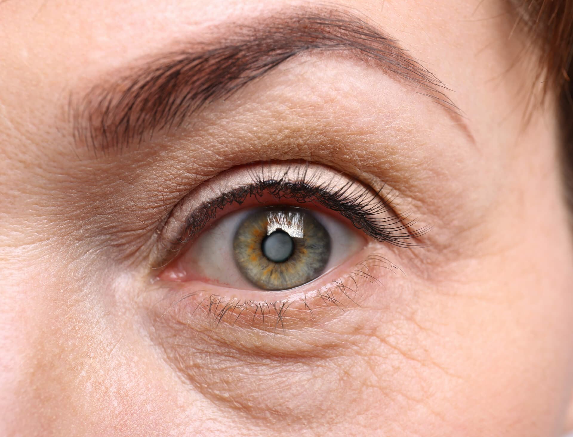 ¿Qué es el glaucoma?